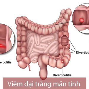 Viêm đại tràng mãn tính những điều bạn cần biết