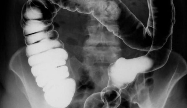 Hình ảnh X-quang là một chẩn đoán thường quy trong viêm đại tràng mãn tính
