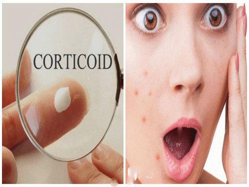 Sử dụng các loại kem dưỡng trắng da có chứa Corticoid sẽ làm tình trạng da tệ hơn