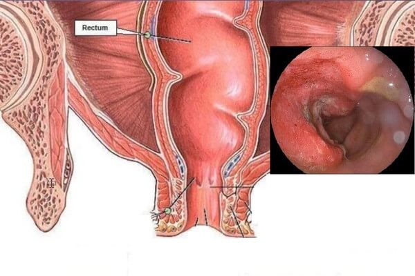 Viêm đại tràng là một bệnh phổ biến và dễ tái lại nếu bạn không có sự duy trì, kiểm soát