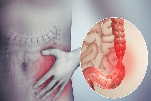 Viêm đại tràng mãn tính một bệnh thuộc viêm ruột phổ biến