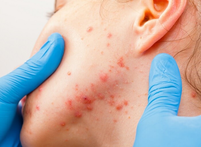 Làn da bị ảnh hưởng nặng nề khi sử dụng các loại mỹ phẩm chứa các thành phần dễ gây kích ứng da