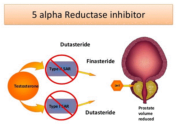 Thuốc ức chê 5-alpha reductase ngăn chặn sự phát triển của tuyến tiền liệt