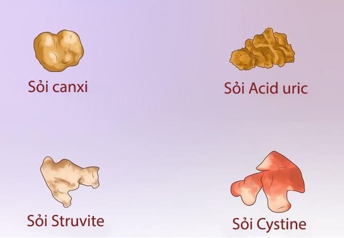 Có 4 loại sỏi thận gồm: Sỏi canxi, Sỏi cystine, Sỏi acid uric và Sỏi Struvite