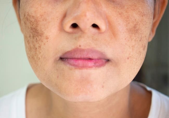 Tình trạng nám da thường xuất hiện nhiều từ độ tuổi 30 trở lên