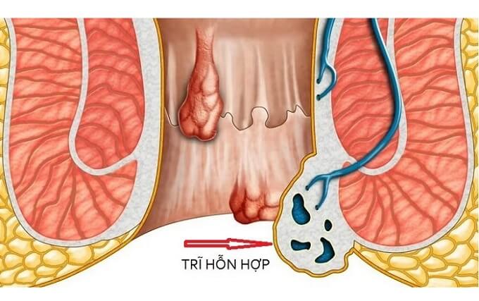 Bệnh trĩ hỗn hợp (mixed hemorrhoids) xảy ra do có sự kết hợp giữa những búi trĩ nội và các búi trĩ ngoại