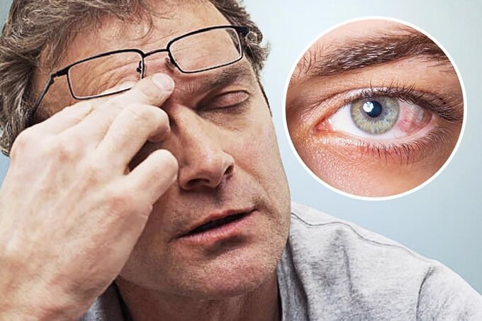 Biểu hiện của tình trạng đau mắt đỏ