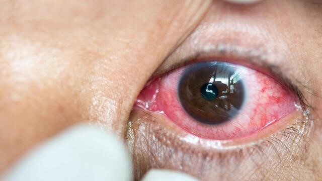 Khô mắt kéo dài khiến nguy cơ nhiễm trùng mắt tăng lên