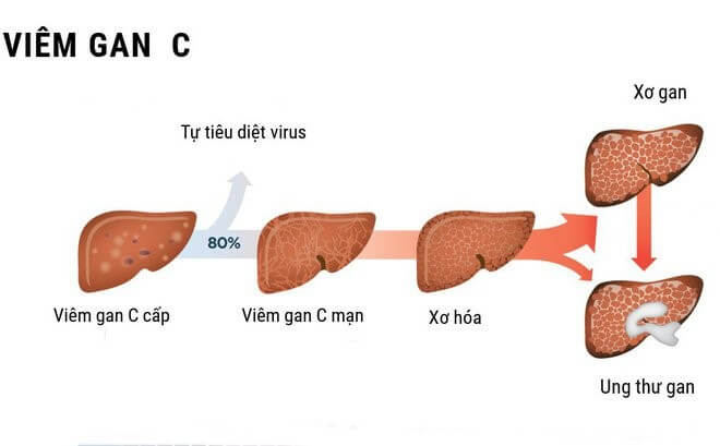 Hình ảnh mô tả căn bệnh viêm gan C nếu không được chữa trị kịp thời