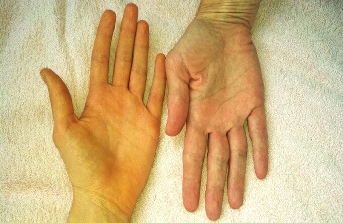 Triệu chứng vàng da là biểu hiện điển hình của các bệnh về gan