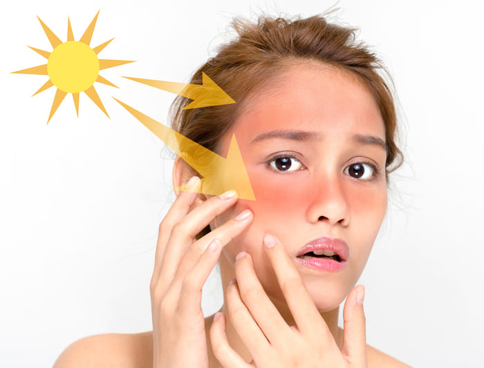 Thường xuyên tiếp xúc với tia UV làm cho da bị tàn nhang