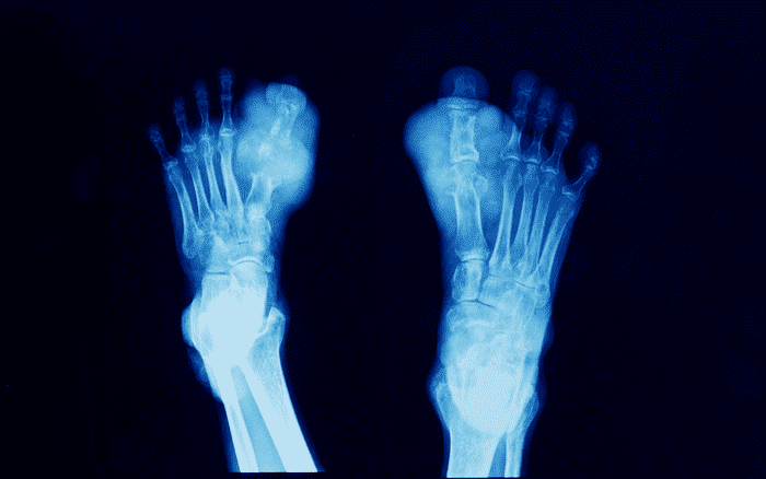 Hình ảnh bệnh gout khi chụp hình x quang gout