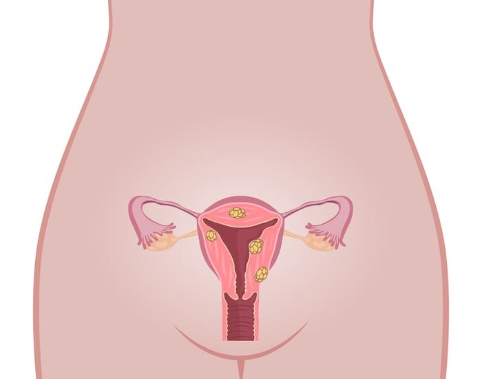 Khối u xơ tử cung có thể phát triển mạnh chèn ép cơ quan xung quanh
