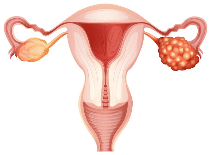U nang buồng trứng khiến nữ giới đi tiểu bị đau