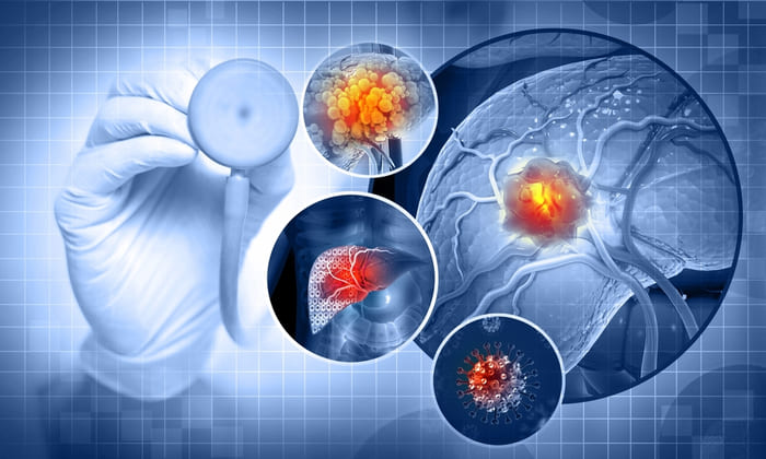 Ung thư biểu mô tế bào gan rất thường gặp