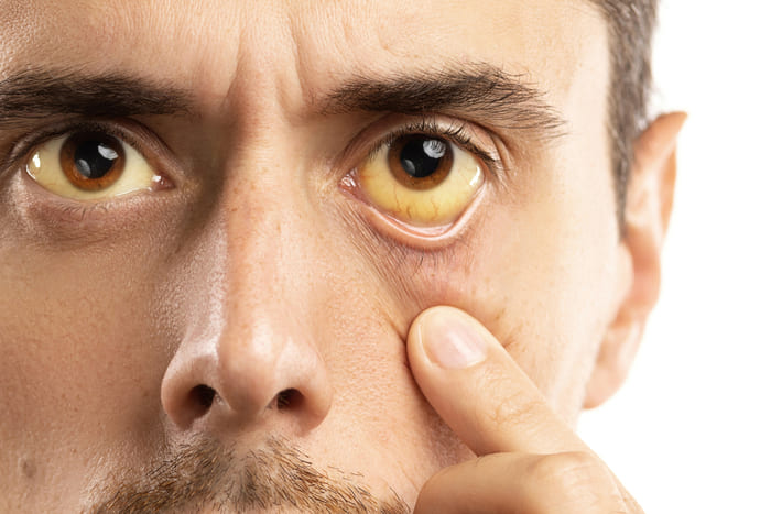 Vàng mắt là dấu hiệu thường thấy ở người mắc bệnh gan