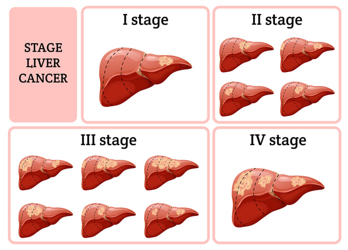 Các giai đoạn của bệnh ung thư gan