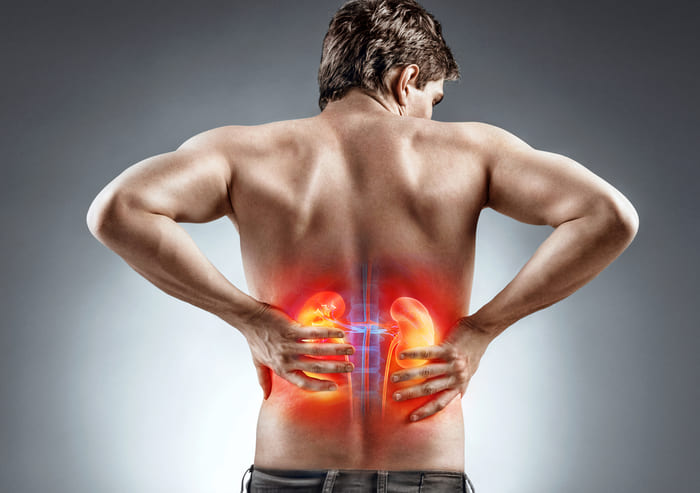 Đau sỏi thận bắt đầu từ thắt lưng